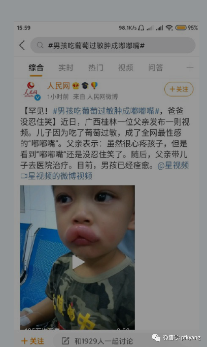 男孩吃葡萄过敏肿成嘟嘟嘴怎么回事？画面详情曝光网友忍不住笑了(图3)